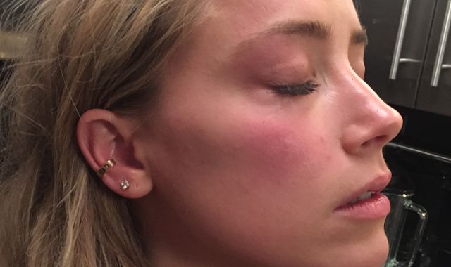 Johnny Depp friend criticises Amber Heard injury photos in court as 'phoney baloney'